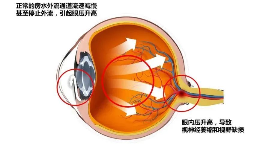 天气寒冷谨防青光眼发生