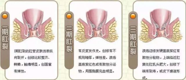 上厕所时肛门总是疼痛流血警惕肛裂找上门