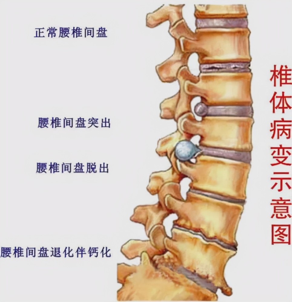 曝格林最新伤病情况!勇士队伤病名称改为腰椎间盘突出,或延长缺席时间