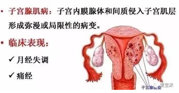 关于子宫腺肌症的一些常见知识