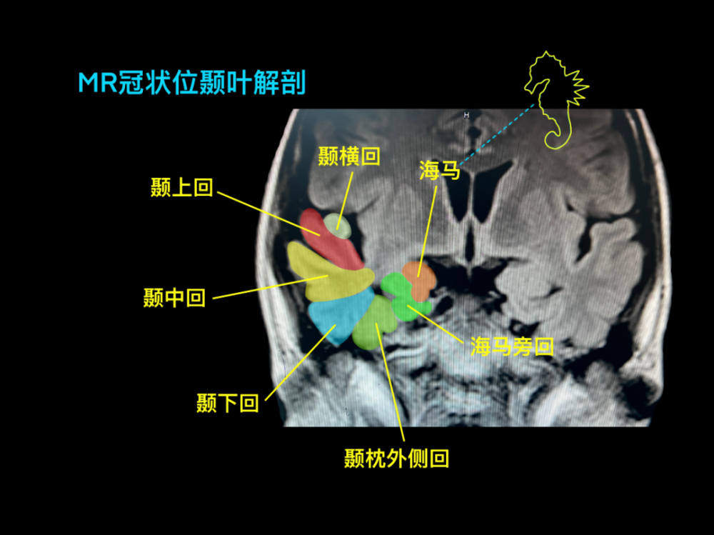 正常垂体大小鞍区的精细解剖"鱼嘴造型"中央沟,边缘沟,扣带回沟,舌叶