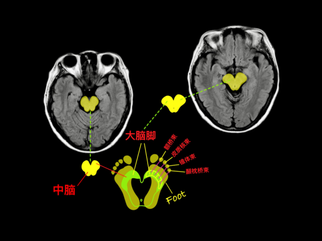 中脑,大脑脚视觉传导通路脑池静脉窦新年快乐!未完待续.