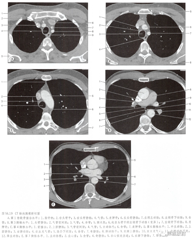 胸部轴位ct增强纵隔窗胸部冠状ct(纵隔窗,肺窗)来源:熊猫放射01.