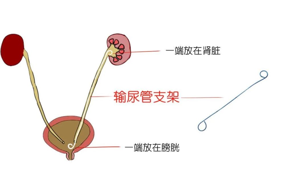 留置了输尿管支架管日常需要注意什么