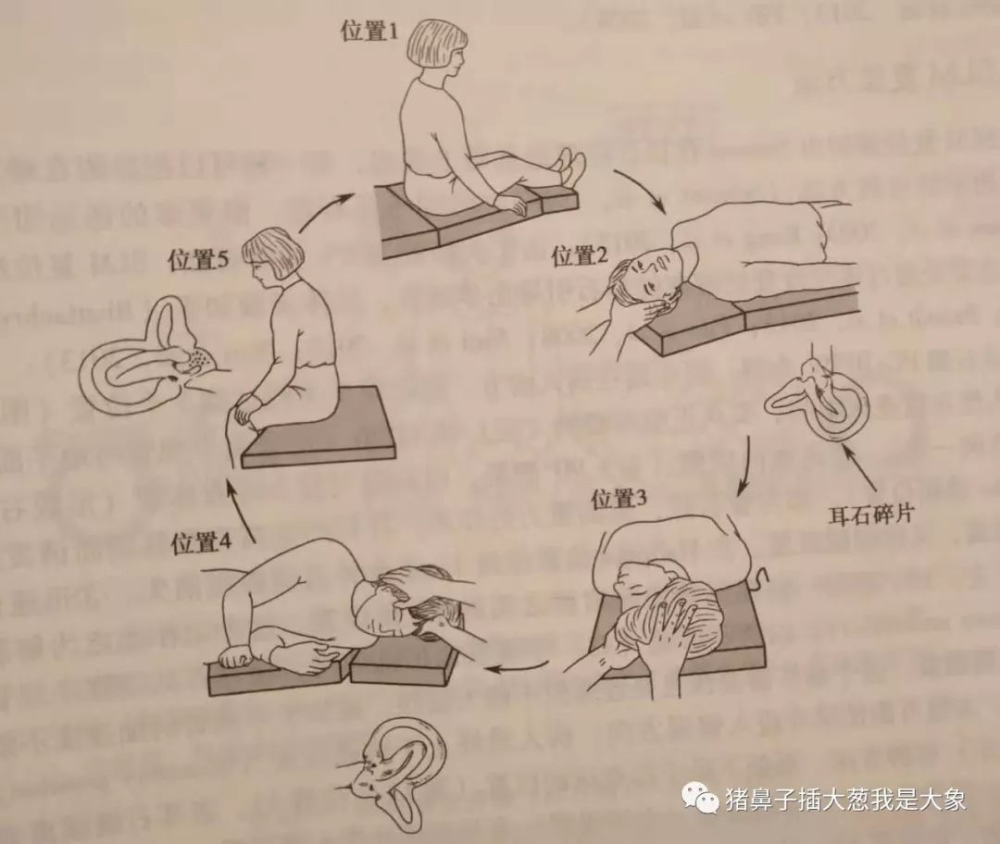 复位无效的后半规管耳石症患者,可以在家中尝试改良型epley法进行自我