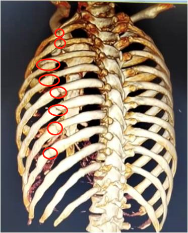 红圈位置为肋骨8个断裂处龙先生被送入医院时,医生检查发现他左侧2-9