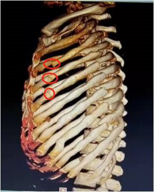 车祸导致肋骨断了8根11处胸腔镜手术补肺接骨避免开胸破膛