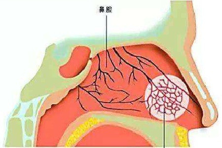造成鼻膜炎的原因都有哪些有何症状表现