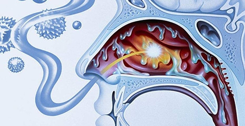 鼻窦炎这种病究竟因何而起