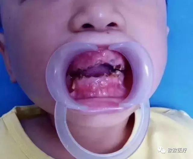 这么多娃的牙齿遭殃,归根到底,还是家长认为乳牙反正都是要替换