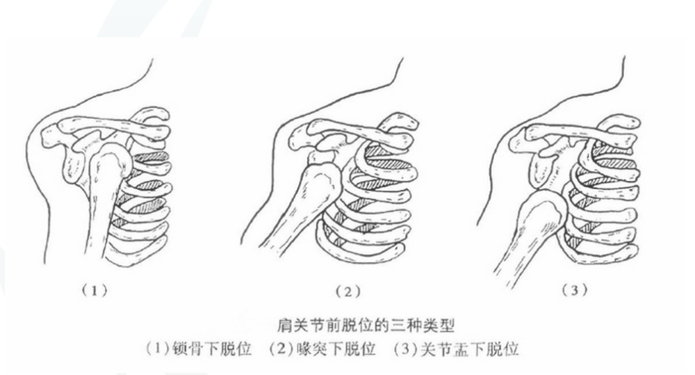 骨科精读最全肩关节脱位的诊治与复位请查收