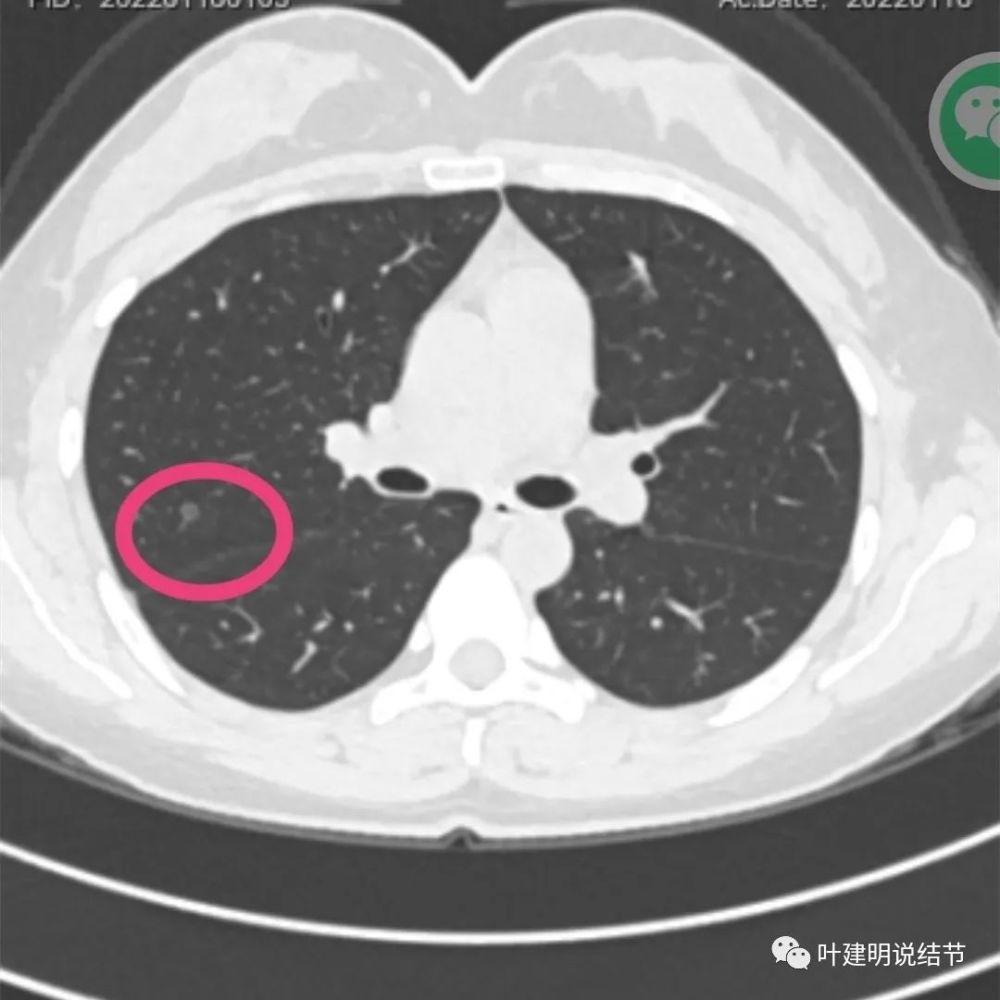 问诊分析2022121年仅32岁的女性肺多发结节有的看上去还挺不好怎么办