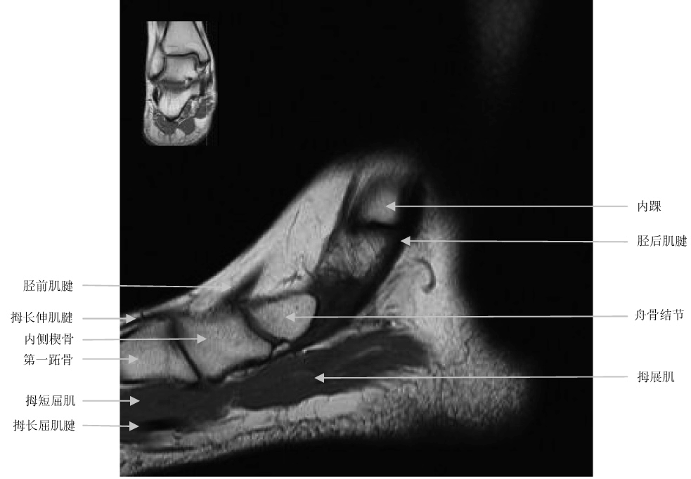一文掌握踝关节mri的断层解剖