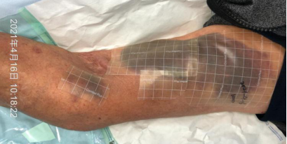 注射低分子肝素后惊现皮下血肿避免局部出血的8条建议