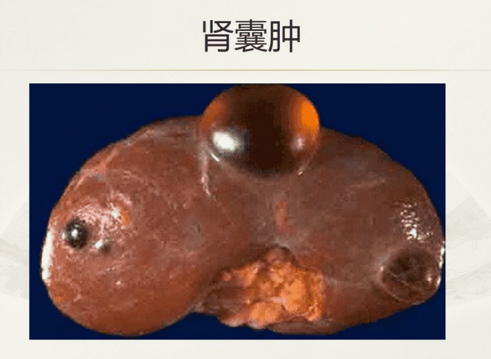 肾囊肿怎会变肾癌