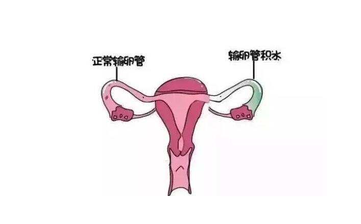 输卵管有积液怎么能消掉