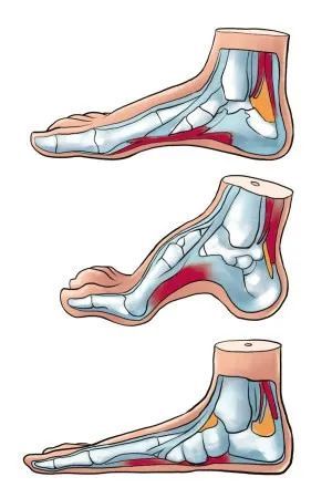 有些患者还会合并足内翻畸形,使得足弓发育异常,出现高弓足.
