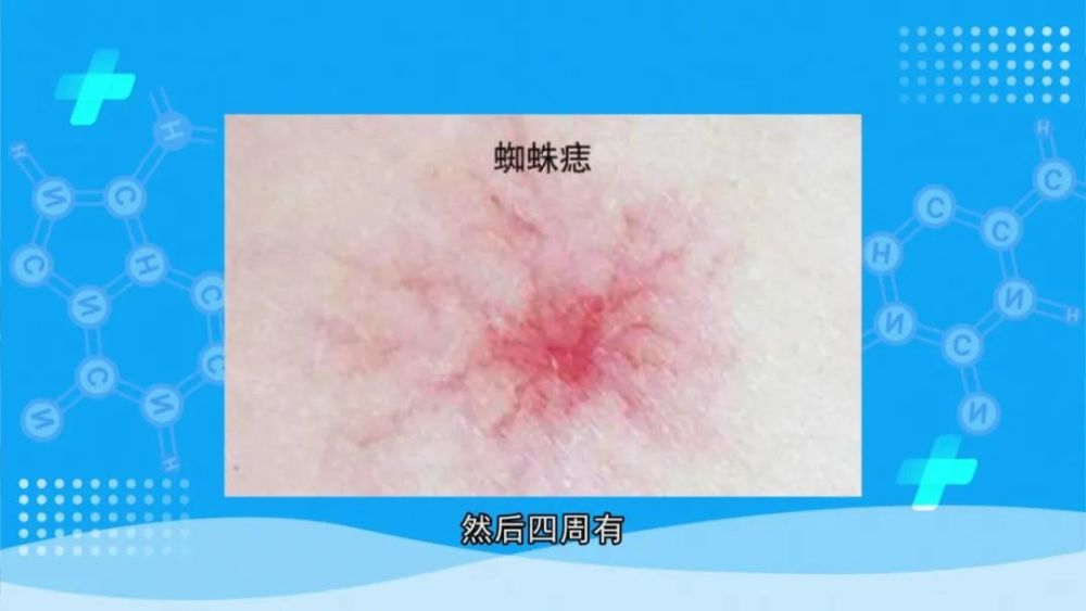 当身体出现蜘蛛形状的红点,或是手掌发红的情况,一定要警惕肝硬化的