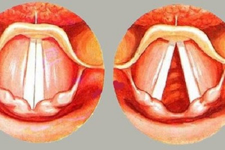喉部检查粘膜多有暗红色充血,肿胀或萎缩,声带肿胀,肥厚,声门闭合不密