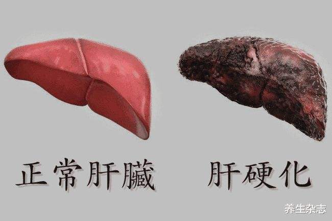 肝硬化早期和晚期的区别