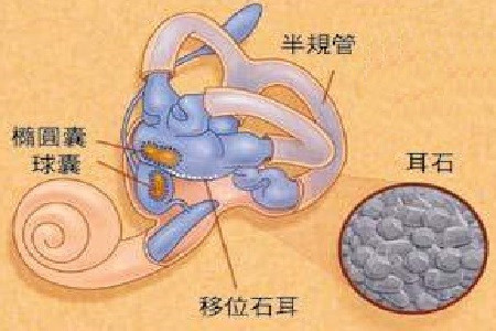 而且健康人群也很有可能会因为这种原因而诱发耳石症