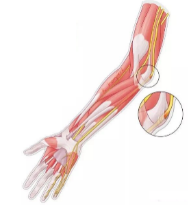 不可忽视的另一病因|手麻|肘管综合征