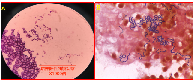 血培养及脓液培养阳性菌落gram染色试验提示该细菌为革兰阳性菌,且为