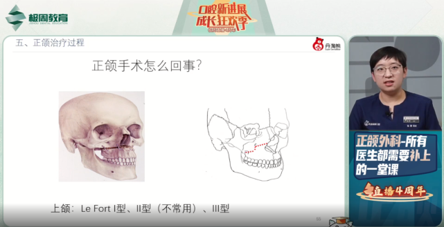 下颌双侧下颌升支矢状劈开截骨术(bssro),是一种比较符颌骨的解剖形态