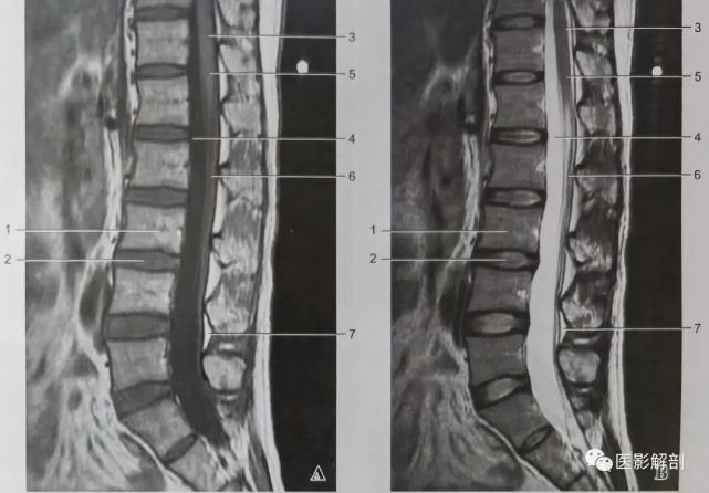 正常胸腰椎的mri解剖