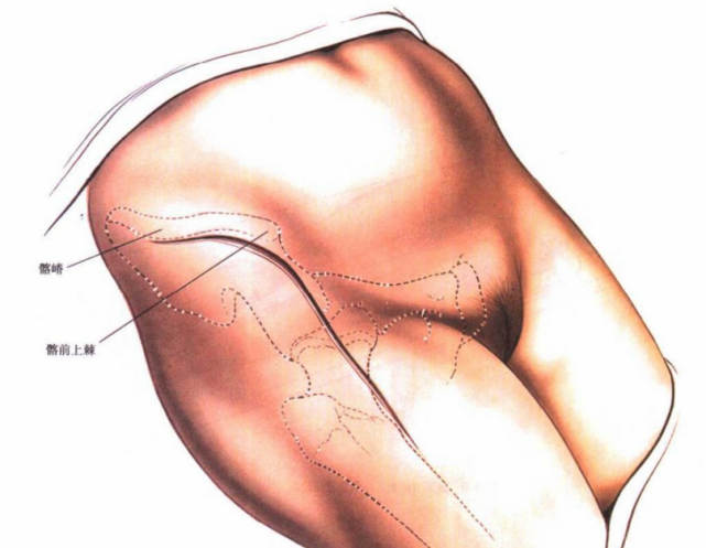 切口髂嵴位于皮下,是多块肌肉的起止点,由于这些肌肉都不跨过髂嵴