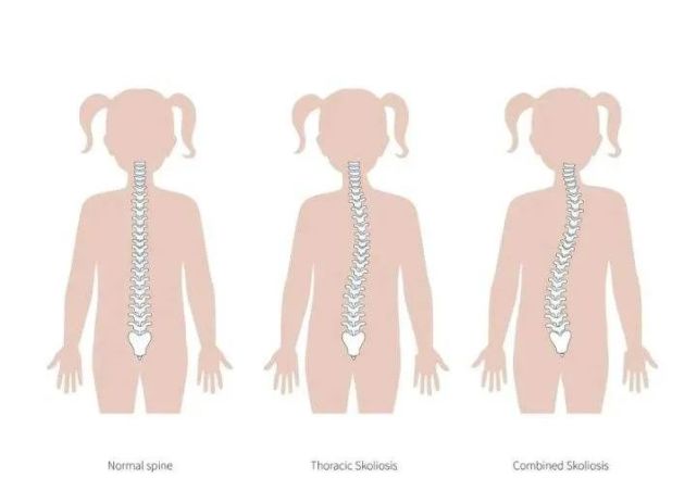 如何判断孩子脊柱侧弯|脊柱侧弯|儿童健康|脊柱棘突