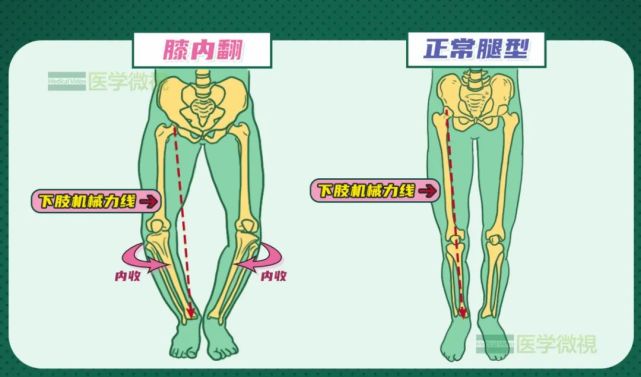 自然站立,两个膝盖却挨不着,是腿变形了吗|o型腿|膝关节|膝盖