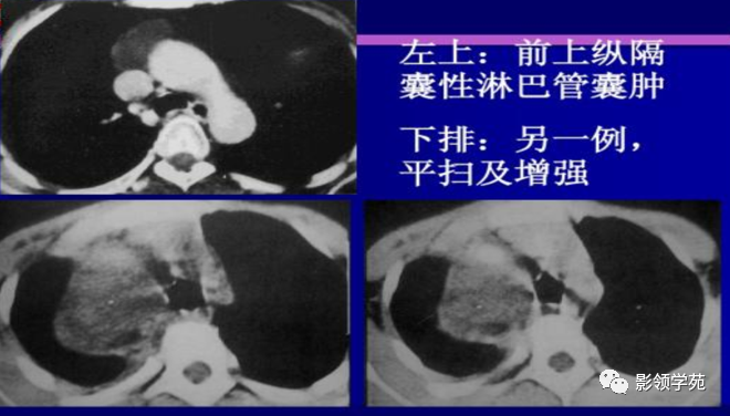 ct表现:是一种先天性淋巴管畸形,囊肿壁内衬内皮细胞,内含淋巴液,增长