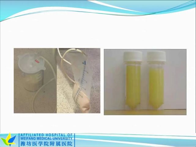 【课件】李莎莎:一例乳糜漏合并2型糖尿病患者营养治疗