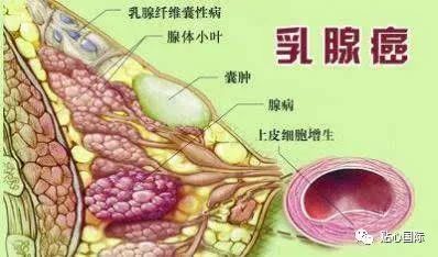 早期乳腺癌纤维瘤或血管瘤长到一定程度,组织就会坏死硬化,早期乳腺癌