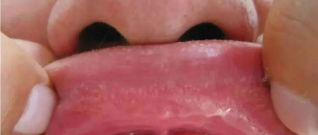嘴唇|皮脂腺|下巴|皮脂腺异位症