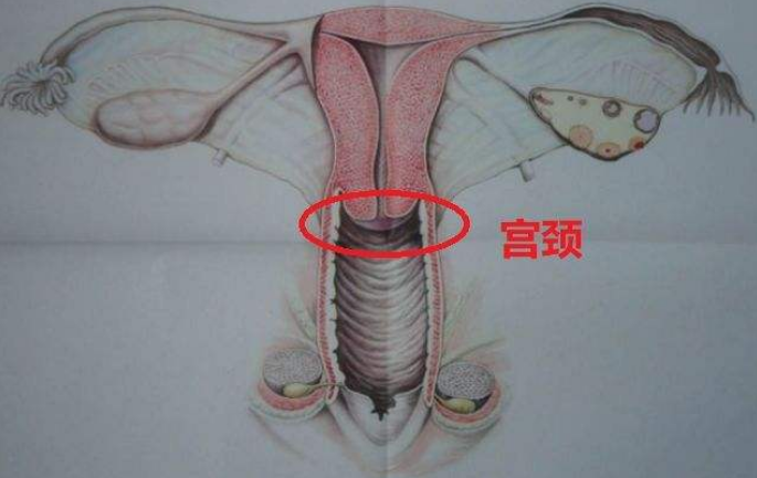 宫颈糜烂和宫颈囊肿有什么区别应该如何治疗