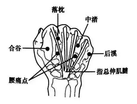 "腰痛穴"又称"腰腿点",其位置相当于原有奇穴"精灵"和"威灵