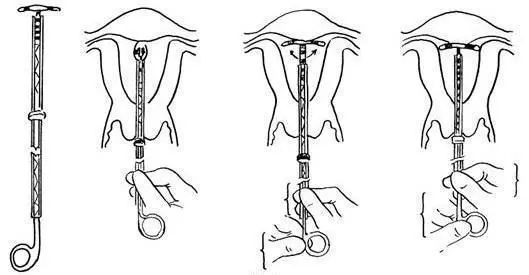 这种节育环会戳穿子宫扎破膀胱妈妈们必须小心