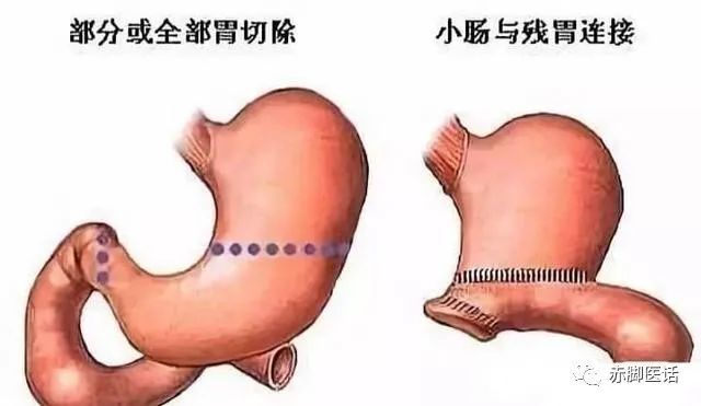 做了胃切除手术后就一定不会得胃癌了吗医生提醒不能放松