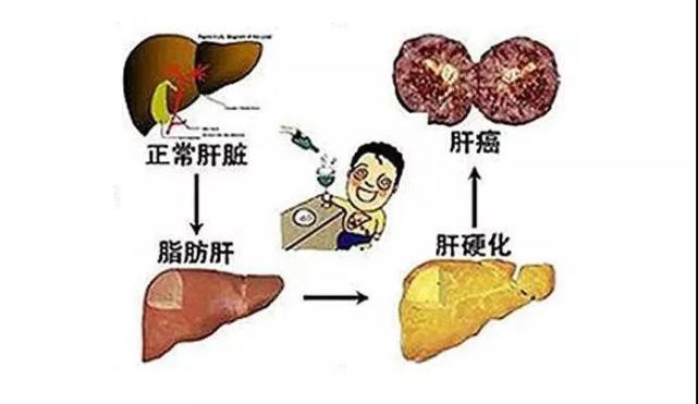 胃底静脉栓塞手术)手术,成功解决了患者门静脉高压及静脉曲张出血问题