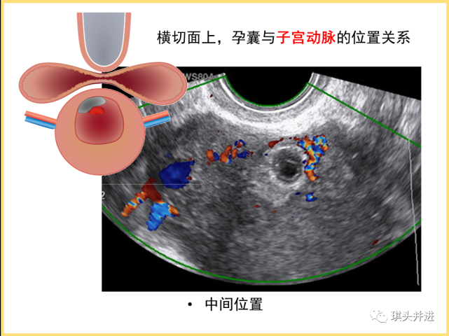 早孕期csp定义及超声评价项目和流程