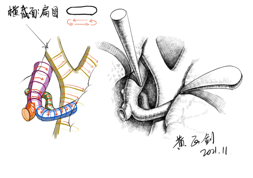 皮瓣-肌肉-骨瓣 局部表现技巧手术入路讲解及练习—翼点入路体位