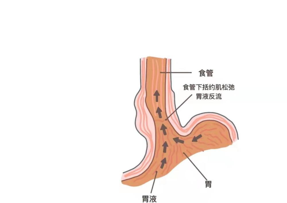 右侧卧也会降低食管括约肌的弹性,导致胃酸反流,对于患有胃食管反流的