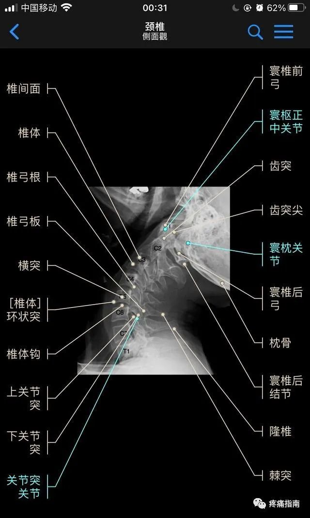 颈椎正位x线片(1,钩椎关节,2,第三颈椎椎体,3,棘突,4,横突(本例4,5钩