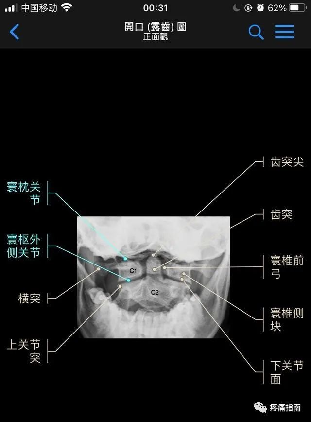 颈椎正位x线片(1,钩椎关节,2,第三颈椎椎体,3,棘突,4,横突(本例4,5钩