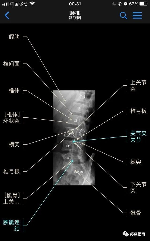 颈椎正位x线片(1,钩椎关节,2,第三颈椎椎体,3,棘突,4,横突(本例4,5钩