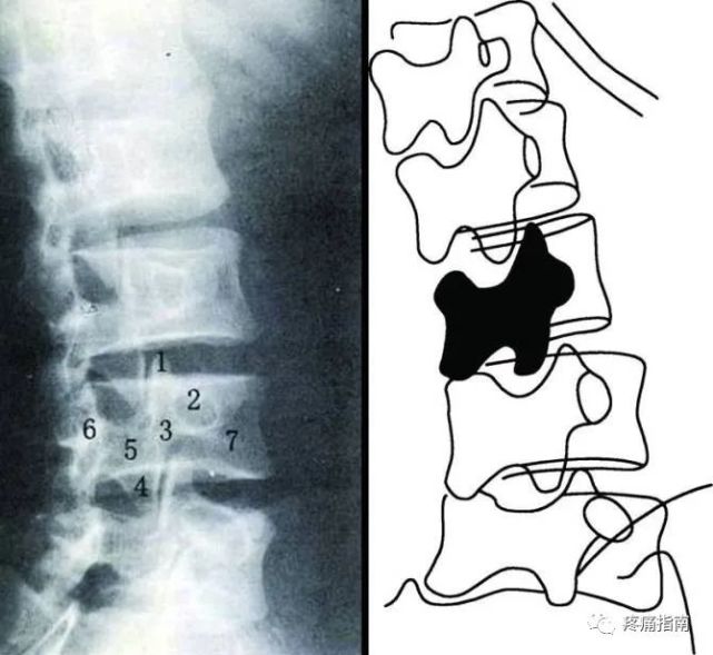 脊柱dr影像基础|脊柱|横突|颈椎
