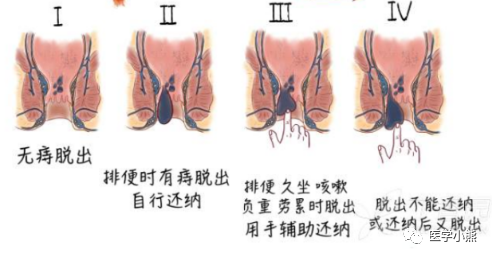 痔疮如何少受苦早康复免开刀