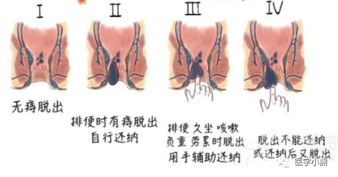 如果已经到了3期,超过了菊花的自愈能力,就必须通过手术去除失去自愈